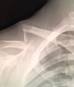 Repairing the broken clavicle was Jamie Anderson's first surgery. Photo/Provided